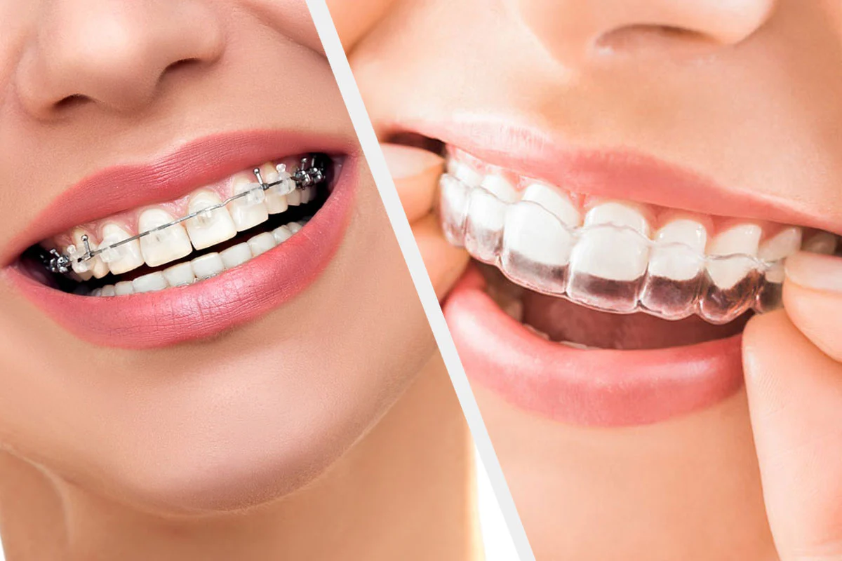 Clinical Orthodontics: Essentials of Braces & Clear Aligners