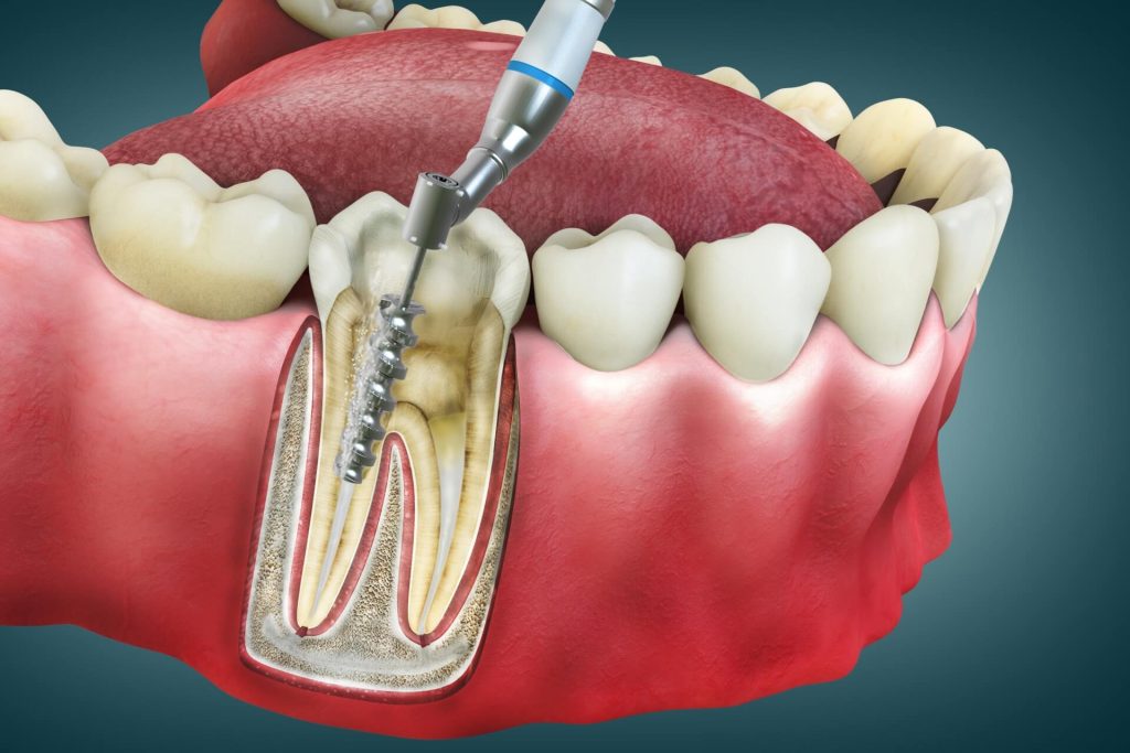 Advanced Endodontics: Mastering Root Canal Techniques