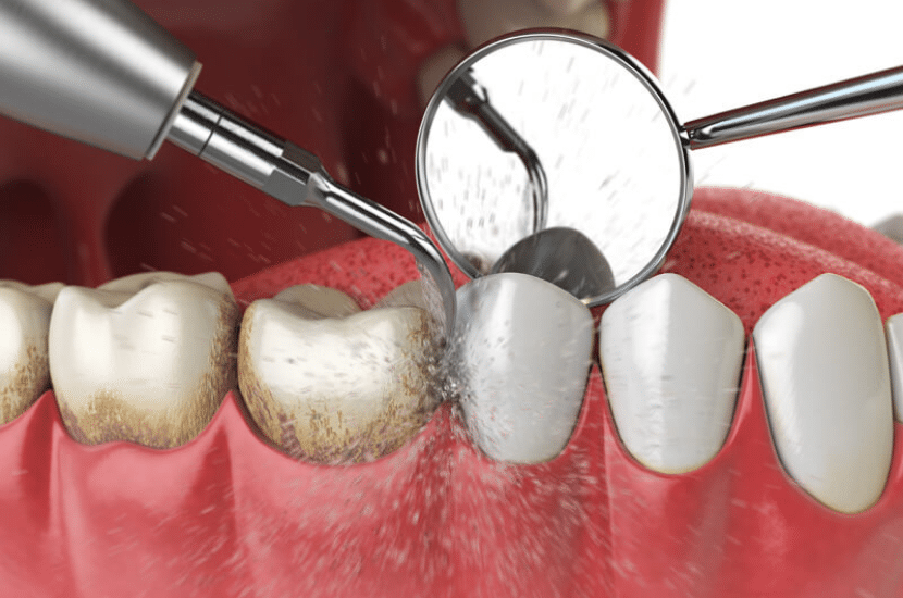 Periodontal Therapy & Gum Disease Management